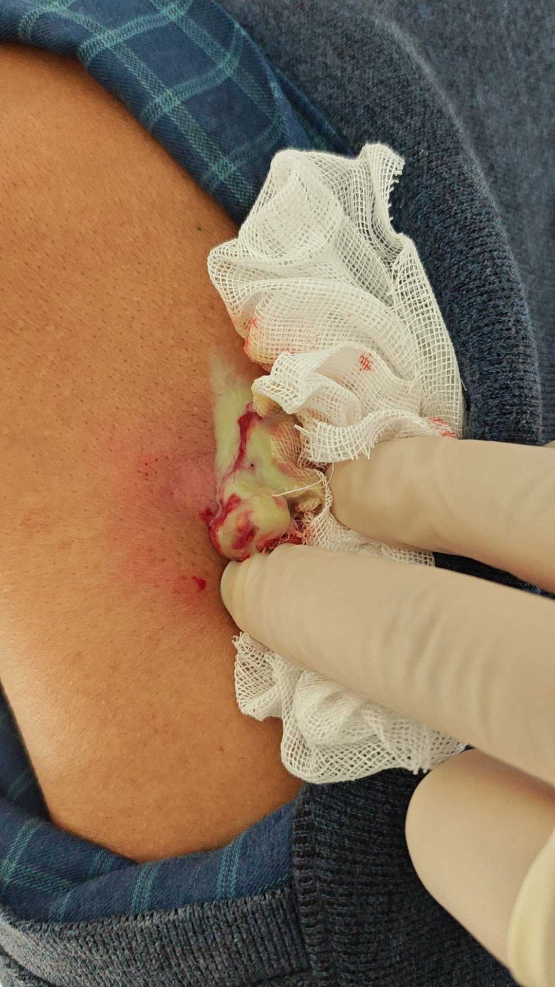 肩部后背皮脂腺囊肿