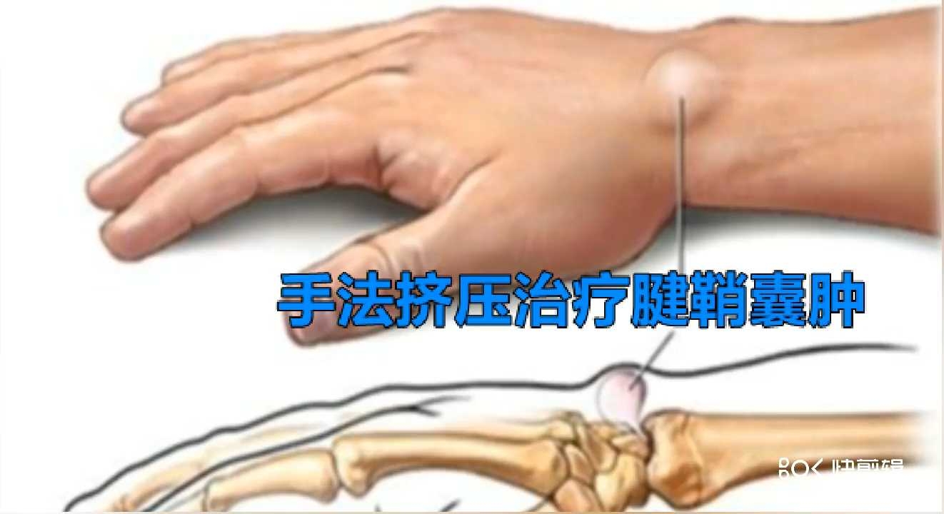 :予以手法挤压消除