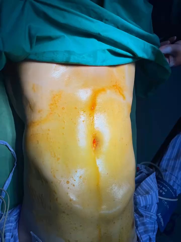 急性化脓性阑尾炎并穿孔