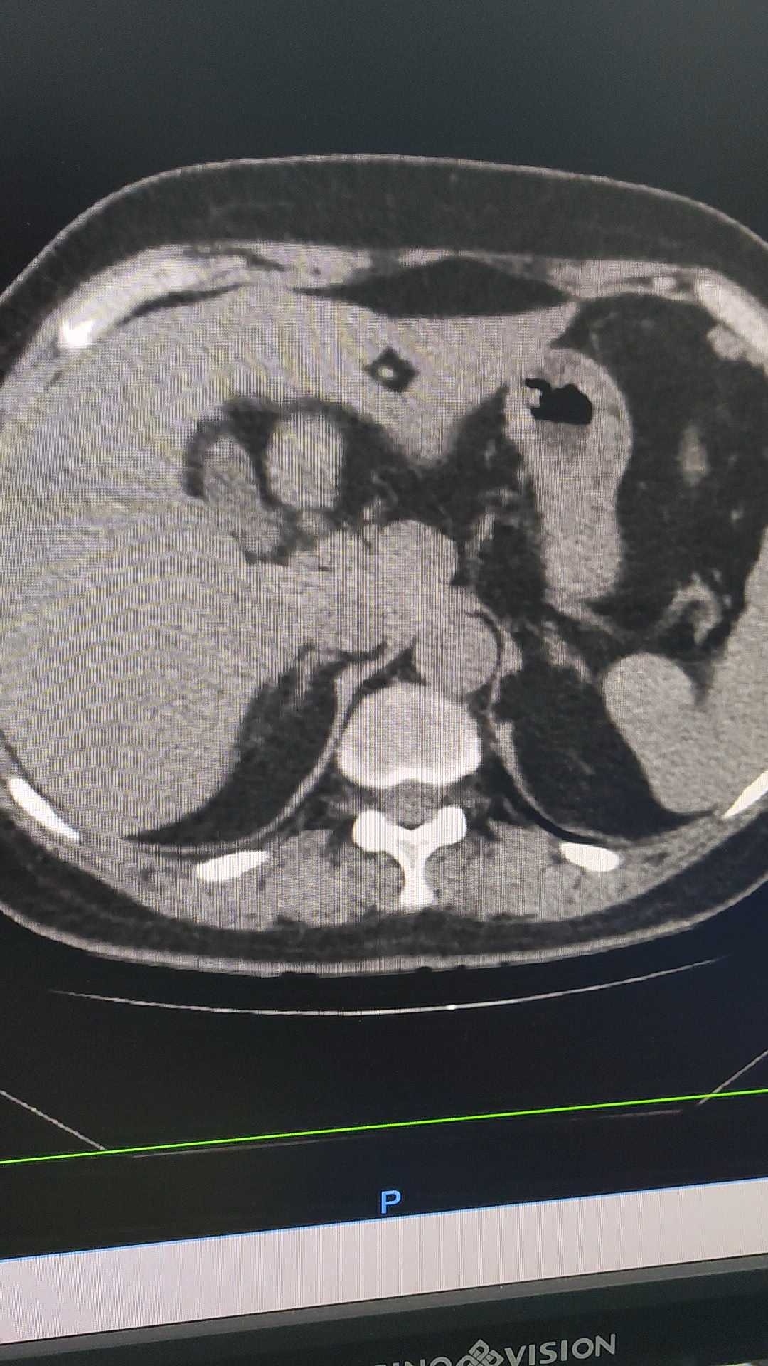胸部ct发现胆囊腺肌症?