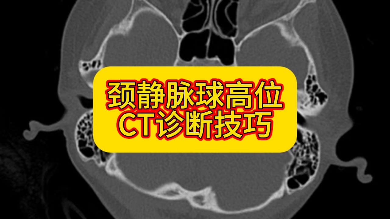 两分钟教会你颈静脉球高位ct诊断技巧