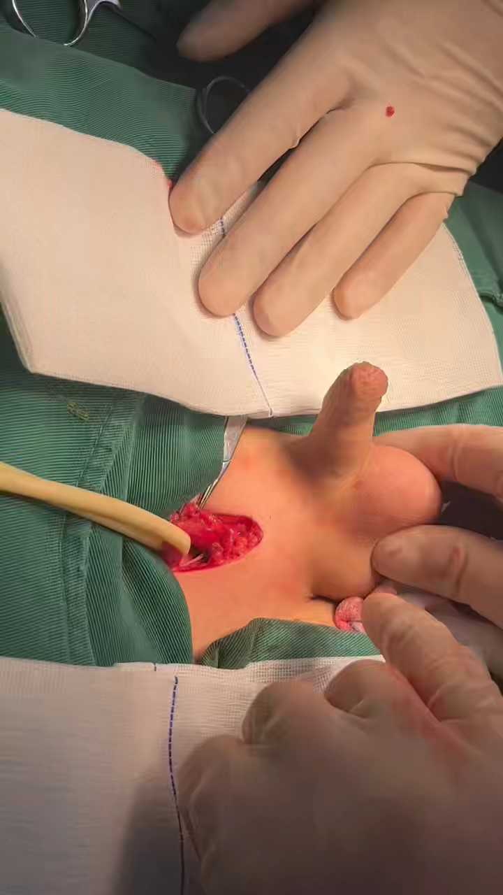 睾丸鞘膜积液合并鞘状突未闭