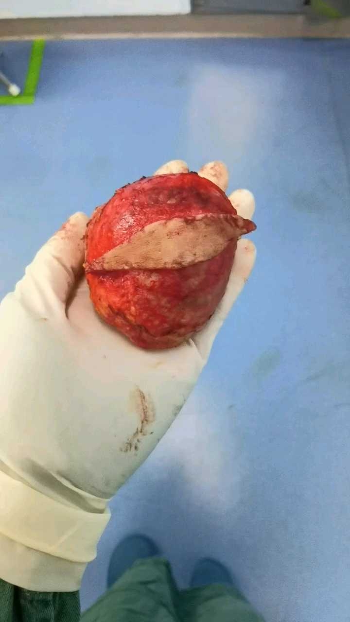 臀部表皮样囊肿一例