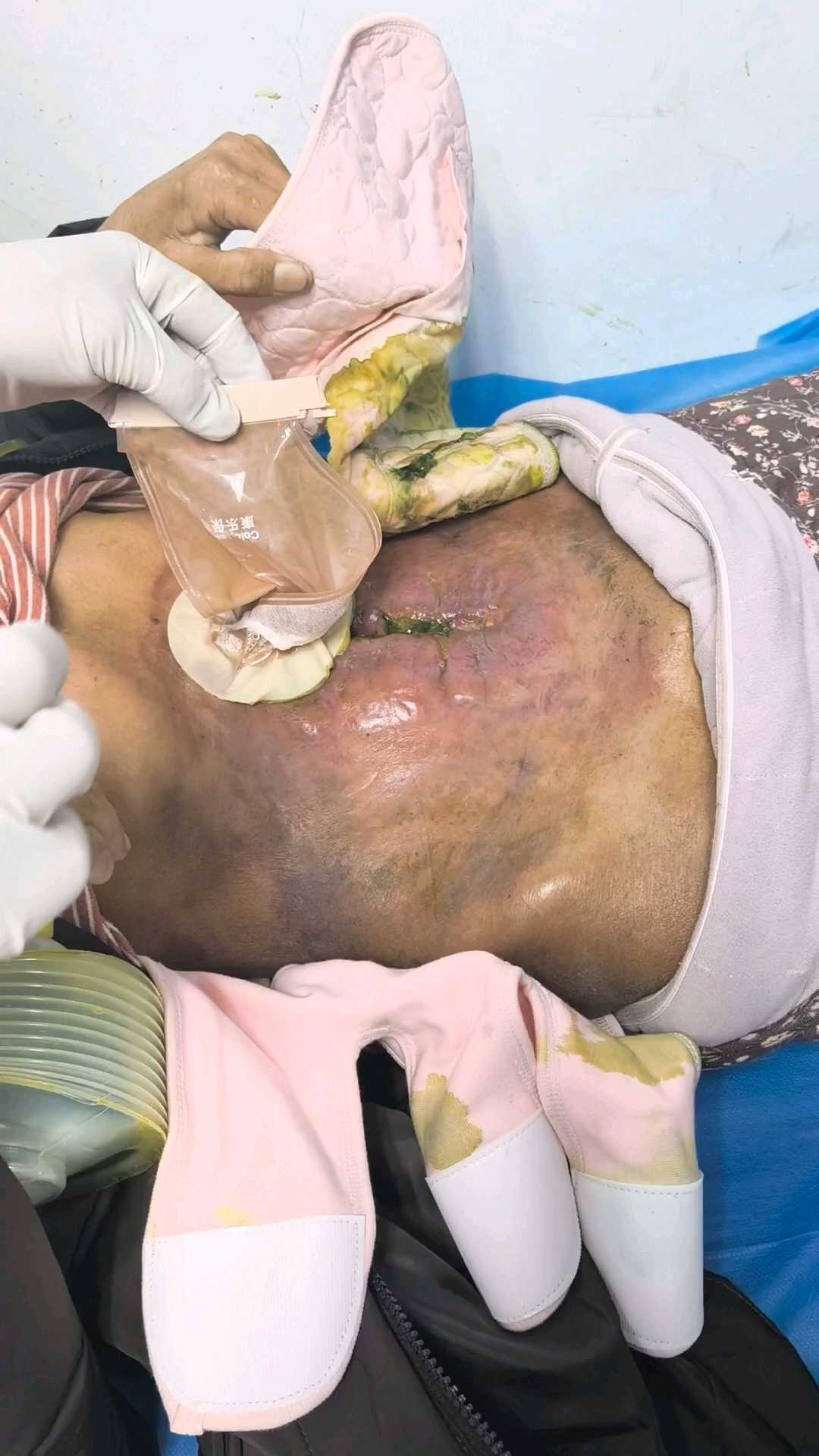  疫情治愈后的后遗症有哪些呢图片视频(疫情治愈后的后遗症有哪些呢图片视频讲解)