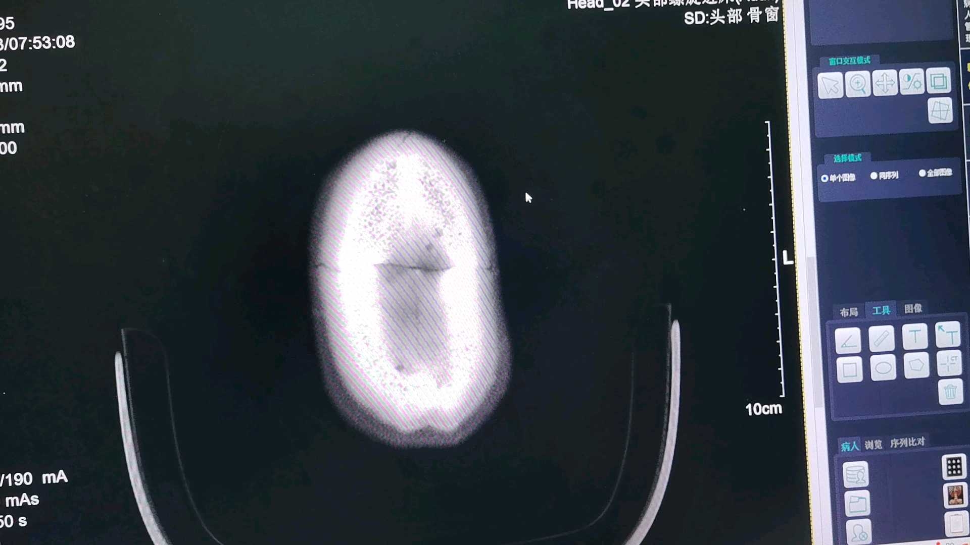患者男 67y 寻常检查