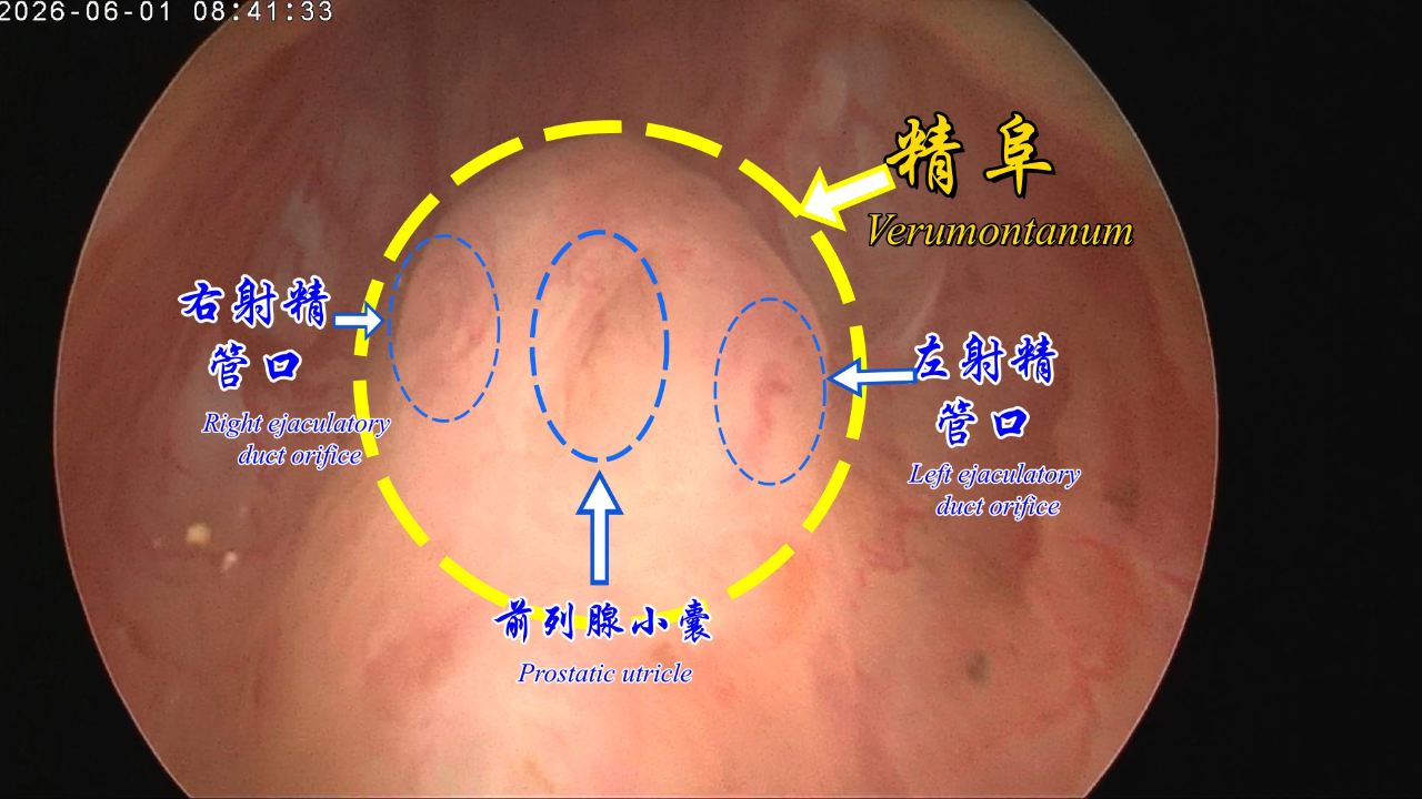 精阜的解剖Anatomy of the verumontanum