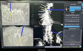 「O」型臂导航系统+「ULIF」助力骨科手术智能化再上新台阶