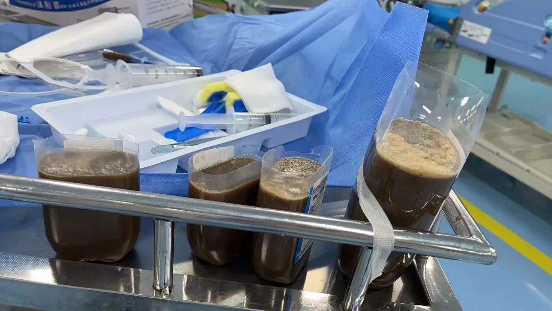 孩子腹部莫名肿胀，需警惕脾囊肿！