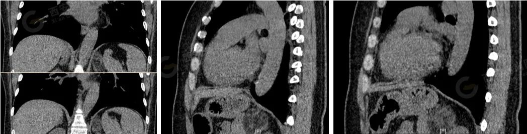 【高尚病例】髓样脂肪瘤 1 例