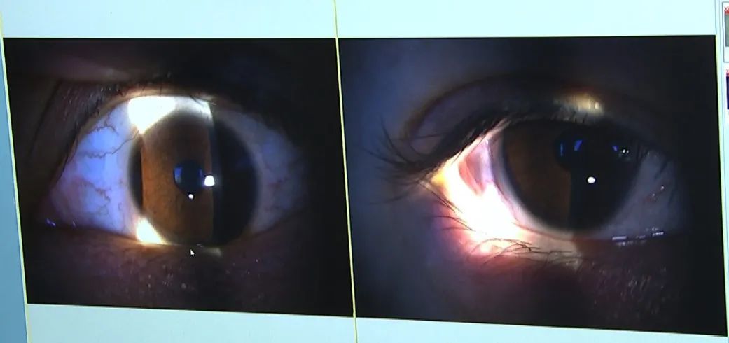 北京茗视光眼科周跃华教授成功为患者验配北京首例四区设计巩膜镜