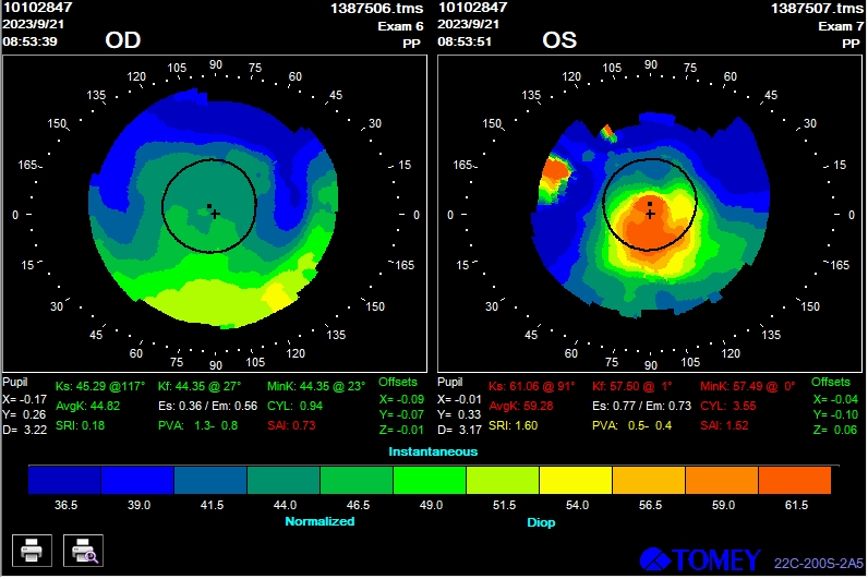 北京茗视光眼科周跃华教授成功为患者验配北京首例四区设计巩膜镜