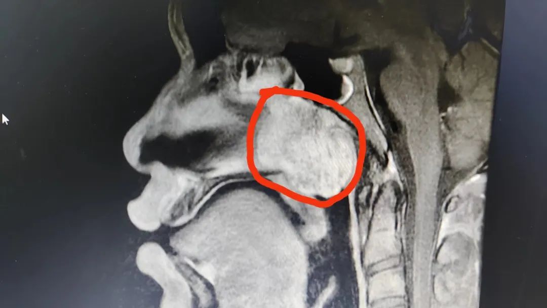 邀请中山一院专家技术指导，佛山市三水区人民医院顺利开展首例「鼻咽巨大纤维血管瘤切除术」