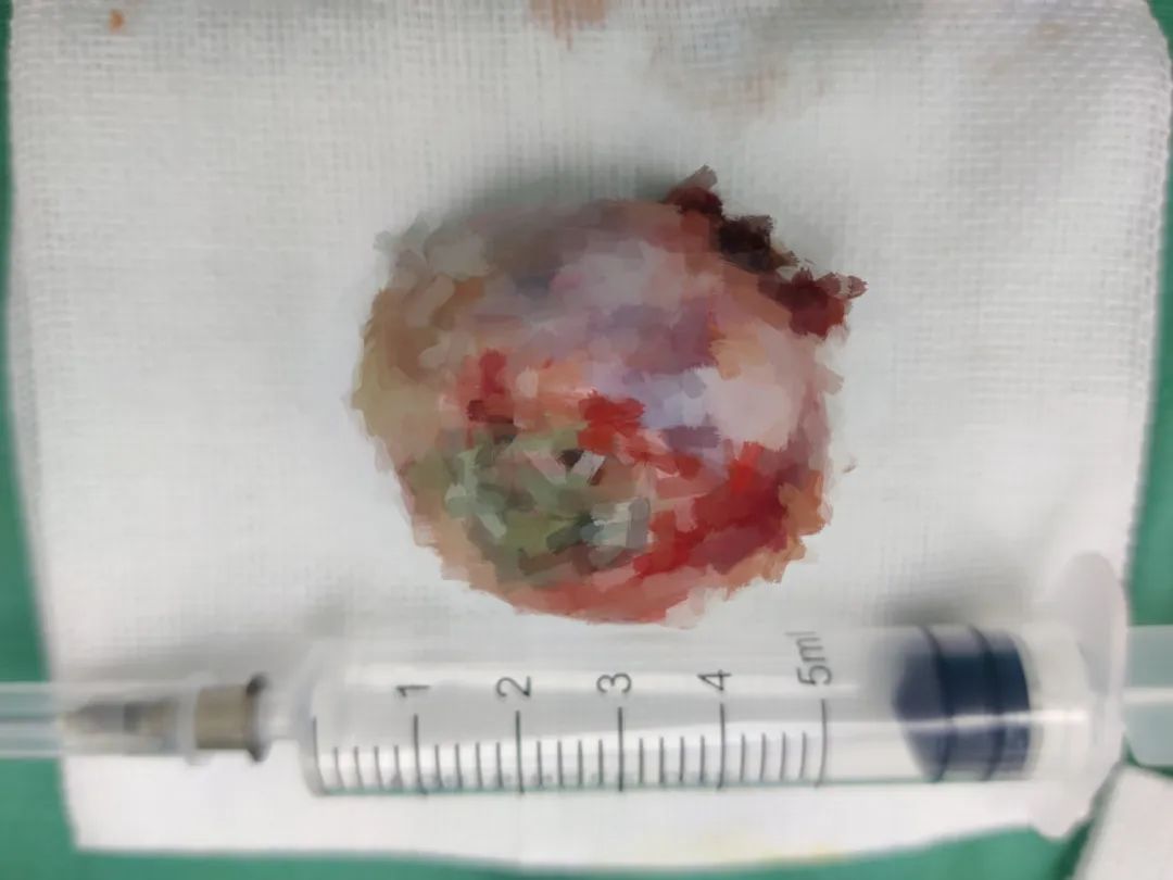 邀请中山一院专家技术指导，佛山市三水区人民医院顺利开展首例「鼻咽巨大纤维血管瘤切除术」