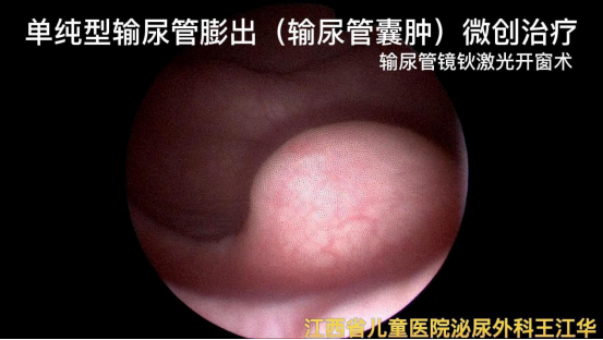 膀胱内「泡泡」引起肾及输尿管积水，病因竟是输尿管囊肿