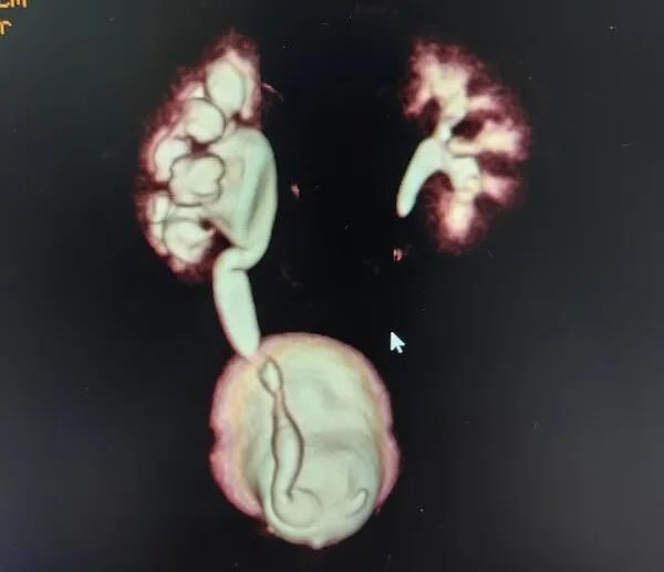 膀胱内「泡泡」引起肾及输尿管积水，病因竟是输尿管囊肿