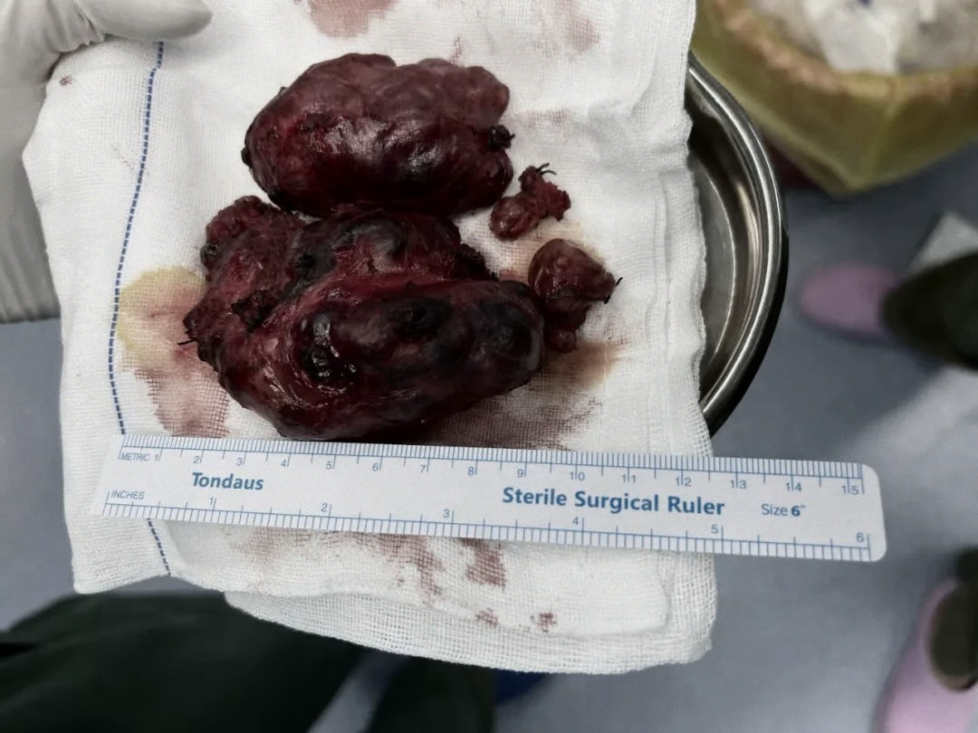 韶关市妇幼保健院成功为患者摘除 11 cm 巨大甲状腺肿