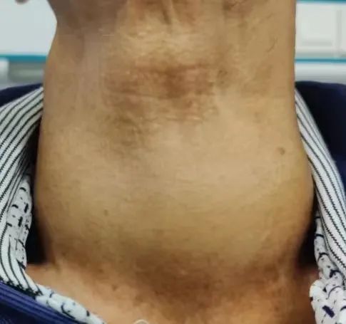 韶关市妇幼保健院成功为患者摘除 11 cm 巨大甲状腺肿