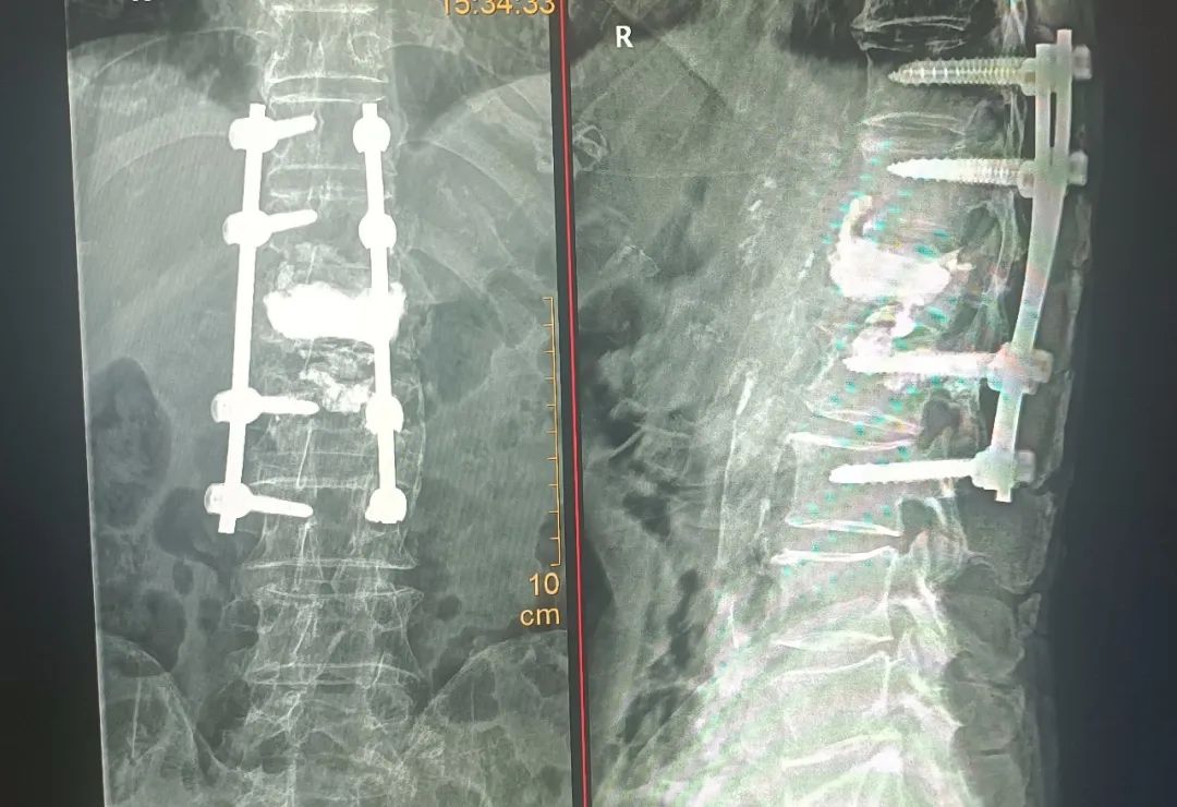 一次手术，让 94 岁高龄老人再次站起来！