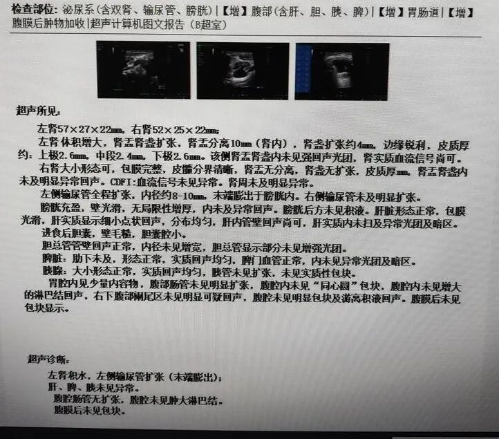 膀胱内「泡泡」引起肾及输尿管积水，病因竟是输尿管囊肿