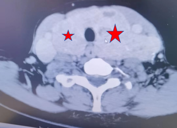 韶关市妇幼保健院成功为患者摘除 11 cm 巨大甲状腺肿