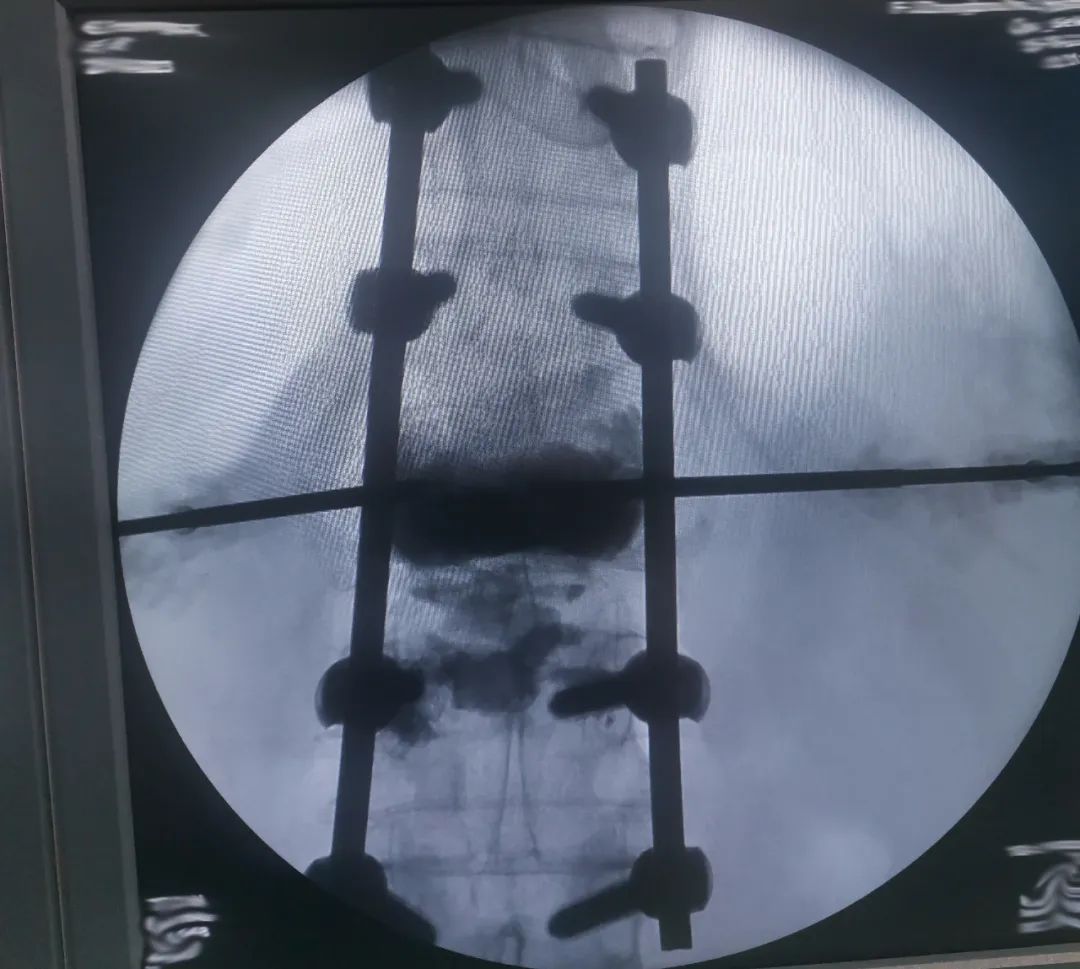 一次手术，让 94 岁高龄老人再次站起来！