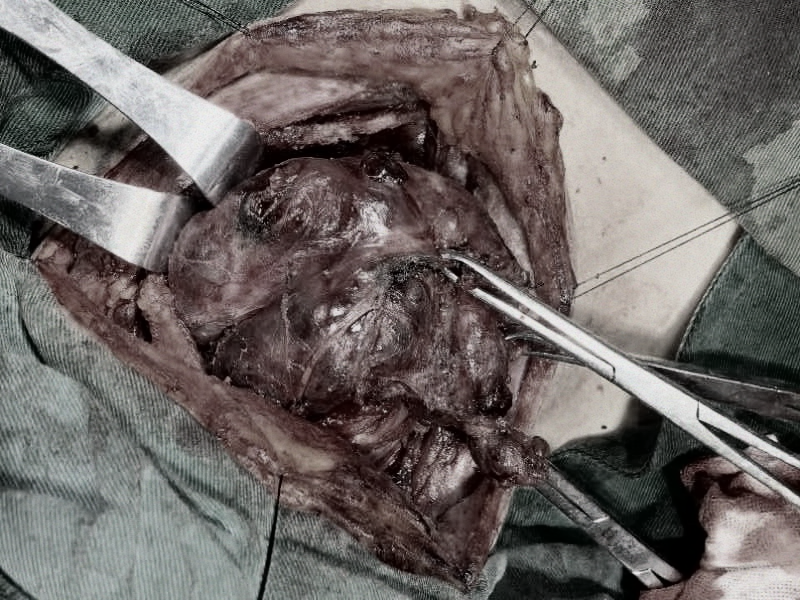 韶关市妇幼保健院成功为患者摘除 11 cm 巨大甲状腺肿