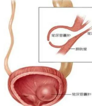 膀胱内「泡泡」引起肾及输尿管积水，病因竟是输尿管囊肿