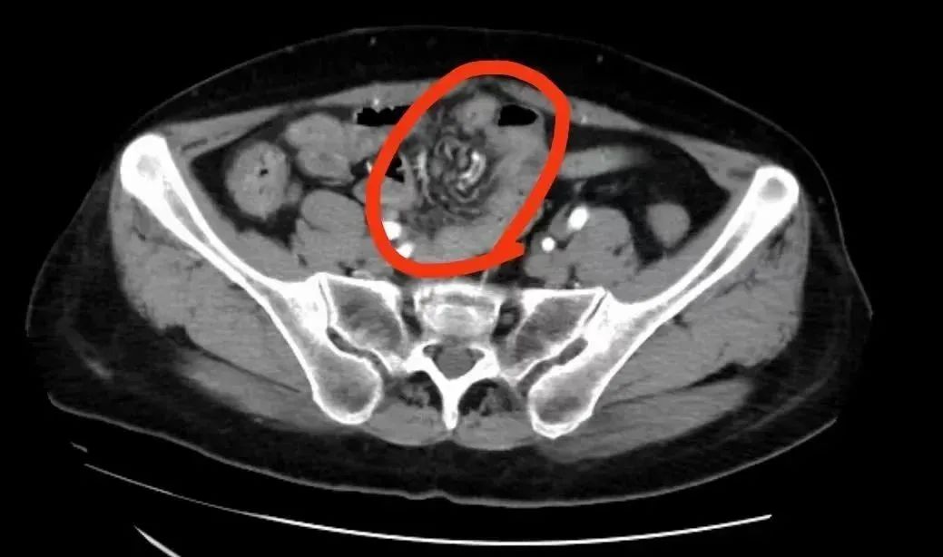 比热恋中的情侣还要「难舍难分」的，是我的腹腔……