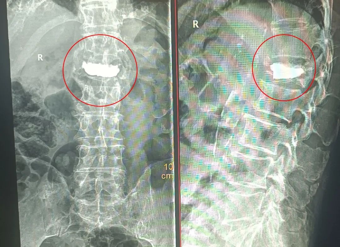 一次手术，让 94 岁高龄老人再次站起来！