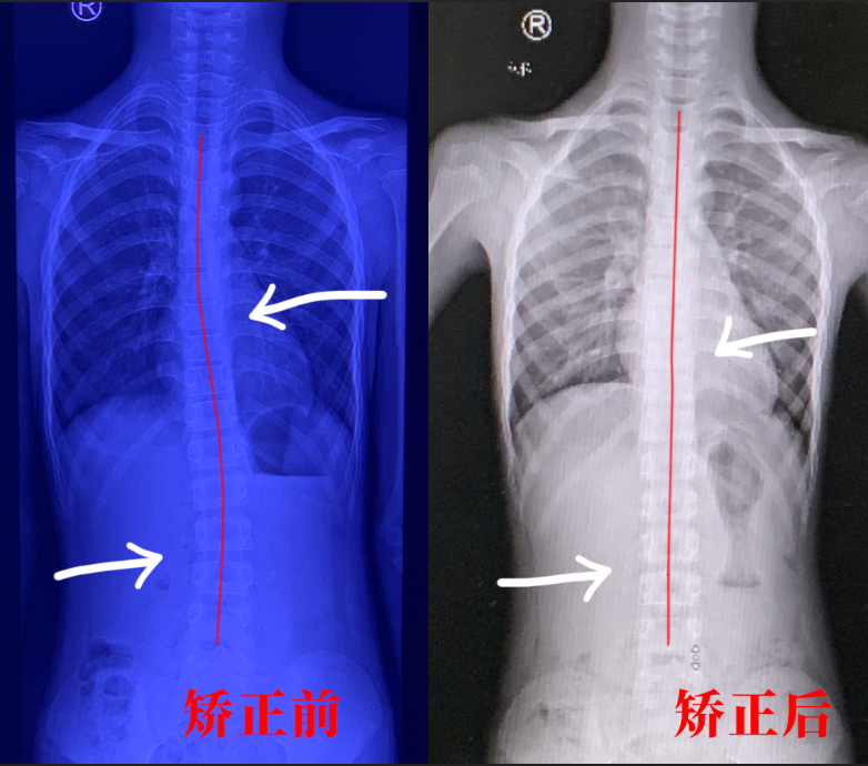 严重脊柱侧弯可致孩子瘫痪