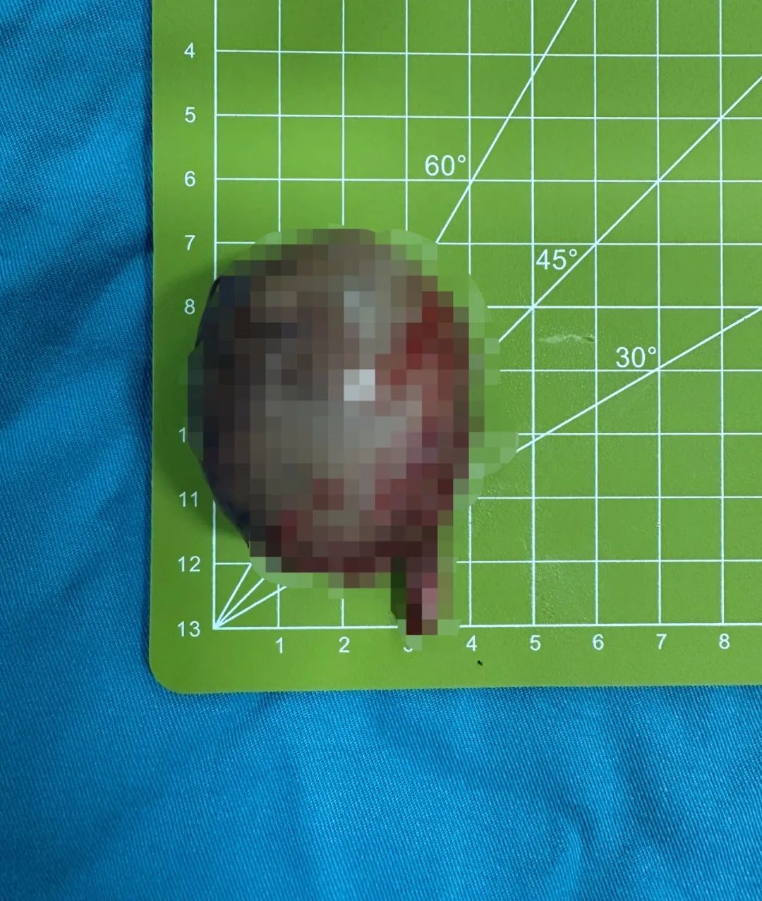 全球发生率 50 万分之一！新生儿睾丸内竟还有「娃」？医生分离罕见寄生胎