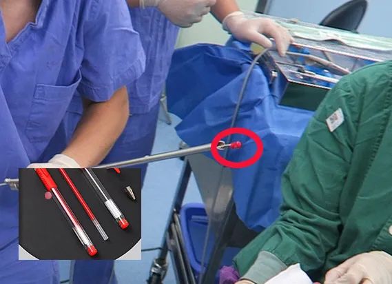 13 岁男童误吸笔帽入气管,江西省儿童医院两分钟取出