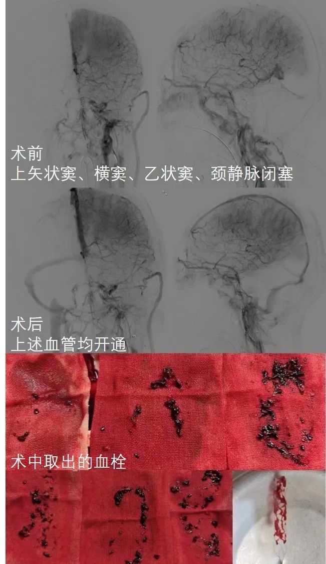 生命至上丨青岛大学附属医院成功救治严重静脉窦血栓合并脑出血危重孕产妇