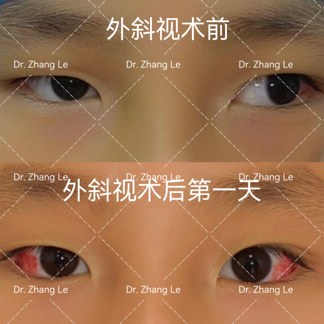 宝宝『歪头斜眼』别大意，可能是这种眼部疾病，要尽早治疗