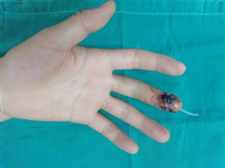 两小时「断指再植」 ，手指指尖再度「复活」