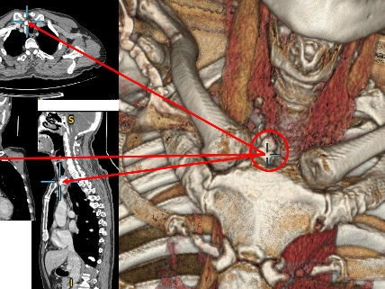 连续奋战 8 小时!青岛大学附属医院成功完成颈胸联合入路的疑难复杂甲状腺手术