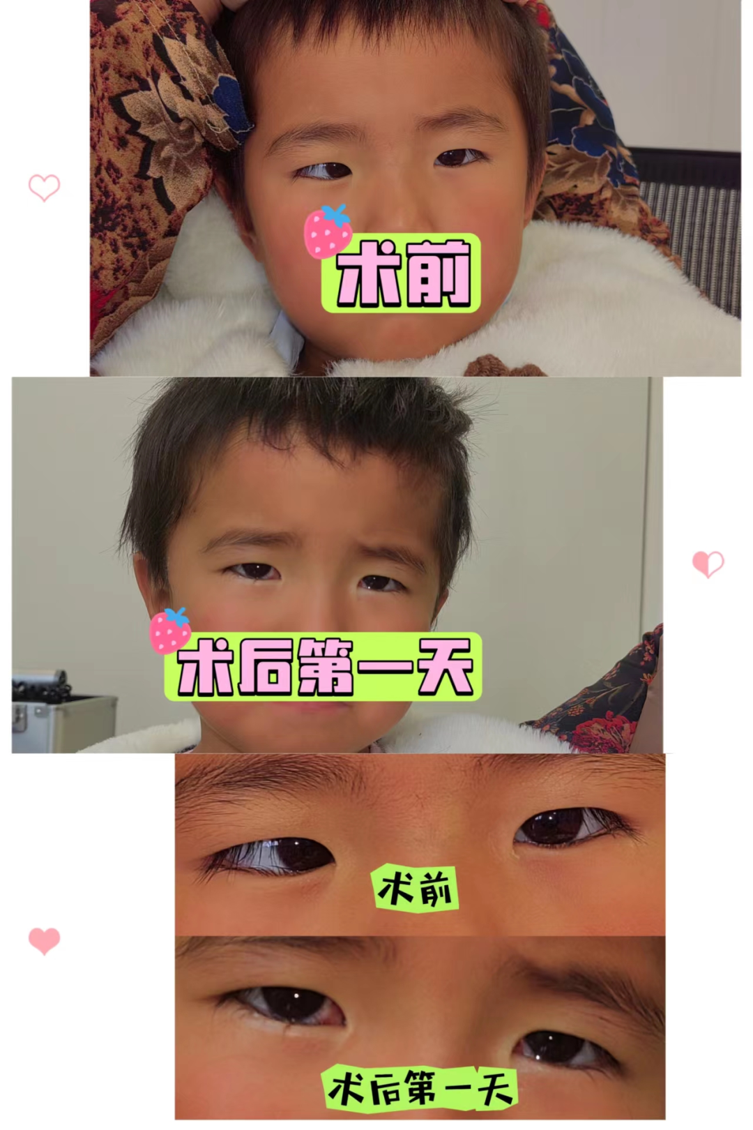 宝宝『歪头斜眼』别大意，可能是这种眼部疾病，要尽早治疗