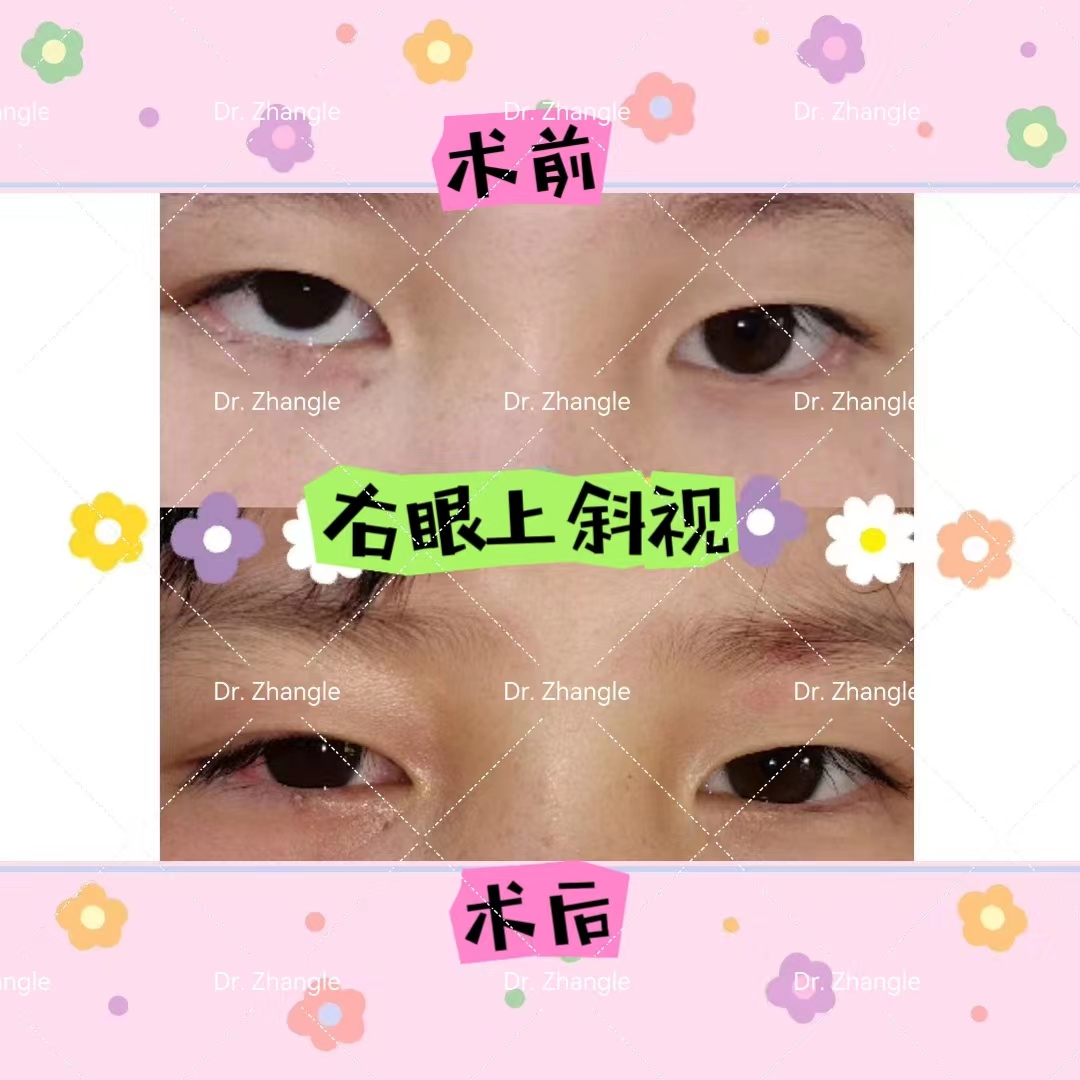 宝宝『歪头斜眼』别大意，可能是这种眼部疾病，要尽早治疗