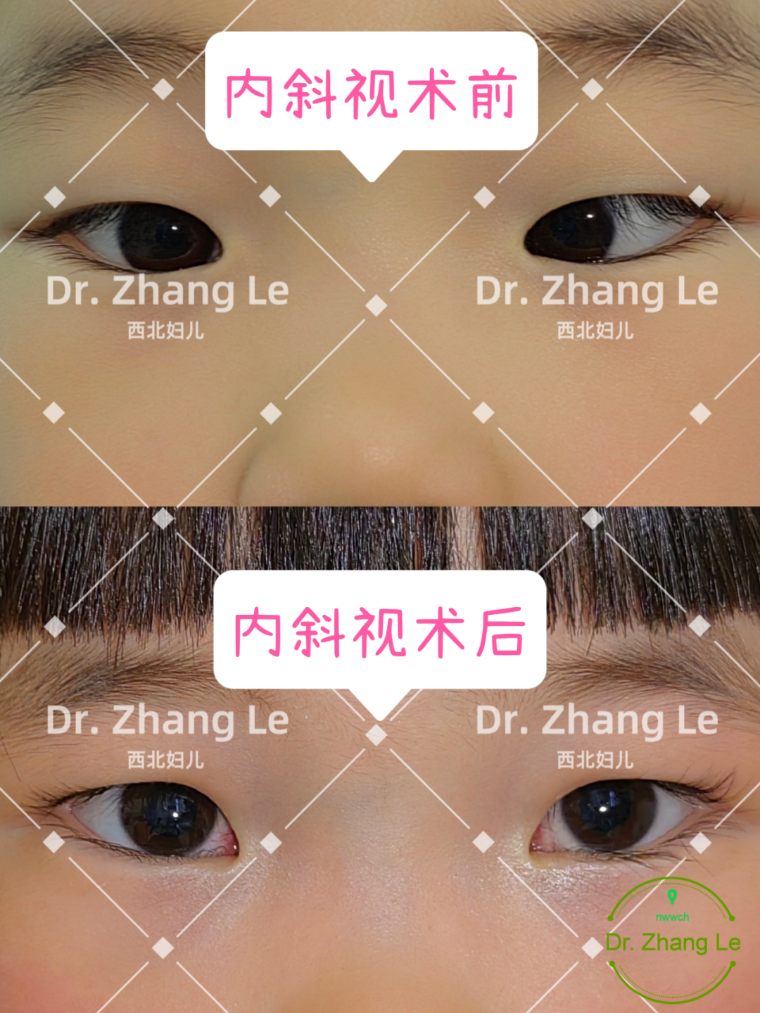 宝宝『歪头斜眼』别大意，可能是这种眼部疾病，要尽早治疗