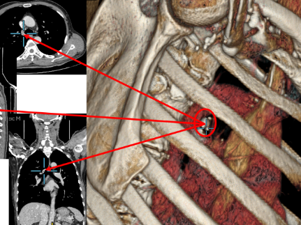 连续奋战 8 小时!青岛大学附属医院成功完成颈胸联合入路的疑难复杂甲状腺手术