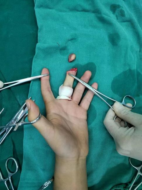 两小时「断指再植」 ，手指指尖再度「复活」