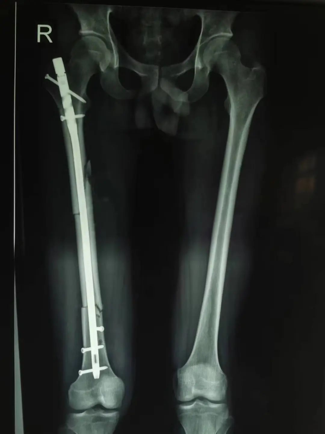 郑州中医骨伤病医院「院前急救→院内急救」无缝对接，全力救治骨折患者！