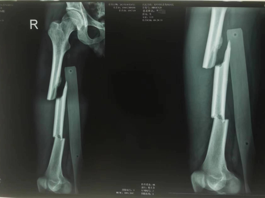 郑州中医骨伤病医院「院前急救→院内急救」无缝对接，全力救治骨折患者！