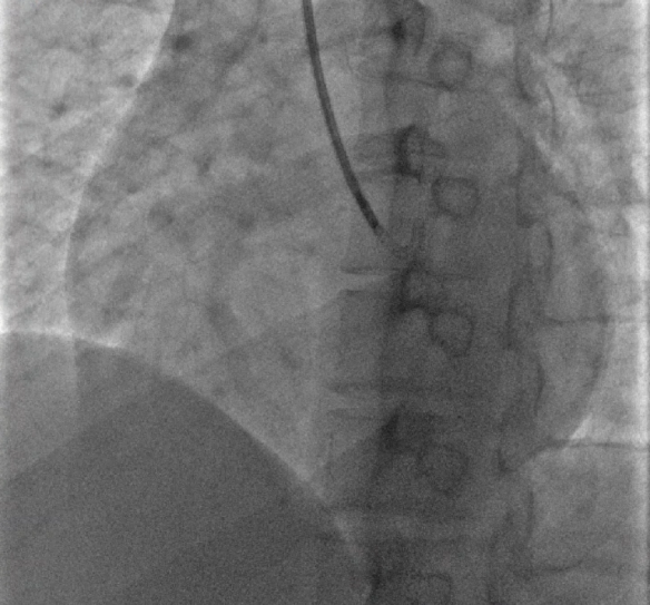 青岛大学附属医院心肌病团队成功救治重度肥胖扩张型心肌病患者