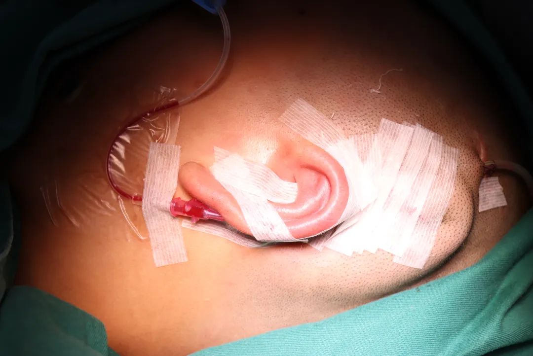 从无到有，耳再造术让小朋友「找回」耳朵