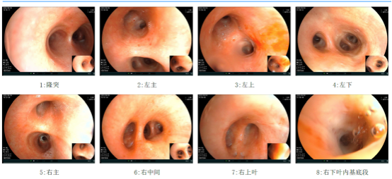 青年女性双肺弥漫性囊变，南昌大学第二附属医院呼吸科让罕见病被看见