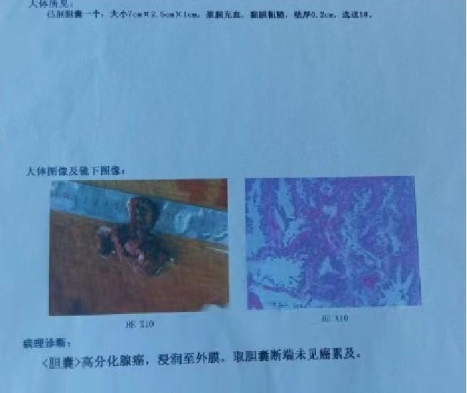 【高尚病例】胆囊癌致高位胆道梗阻 1 例