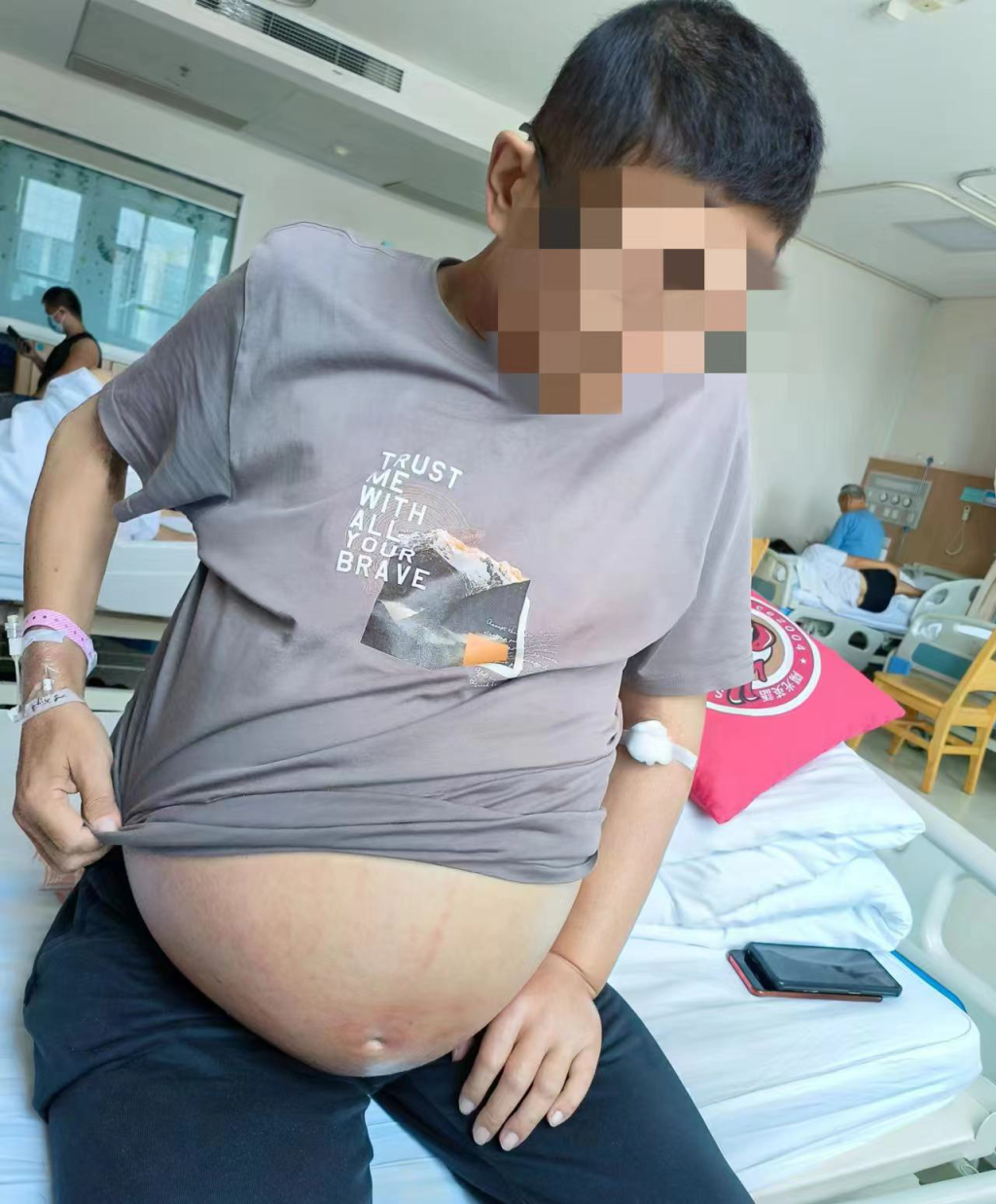 青岛大学附属医院 10 小时肝肾联合移植，成功卸下 40 斤腹部肿物