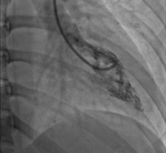 青岛大学附属医院心肌病团队成功救治重度肥胖扩张型心肌病患者