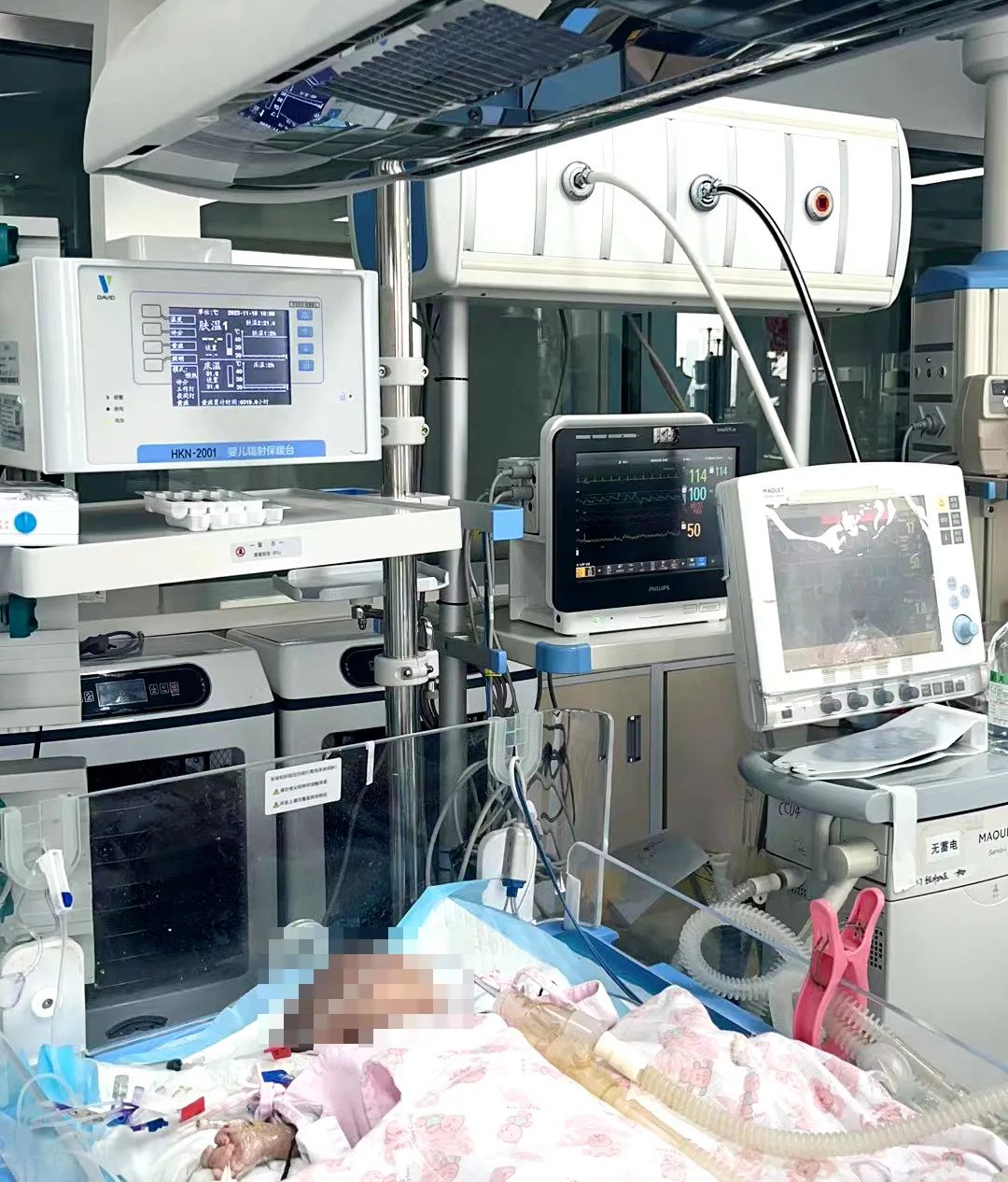 高难度心脏手术，让 9 日龄男婴错位心脏血液循环恢复正常